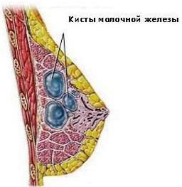 Как распознать мастопатию